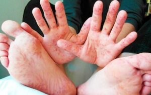 У Києві фіксують спалах кору та гепатиту А